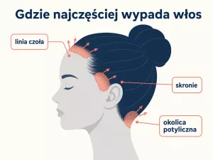 Łysienie trakcyjne: co to jest, przyczyny i leczenie